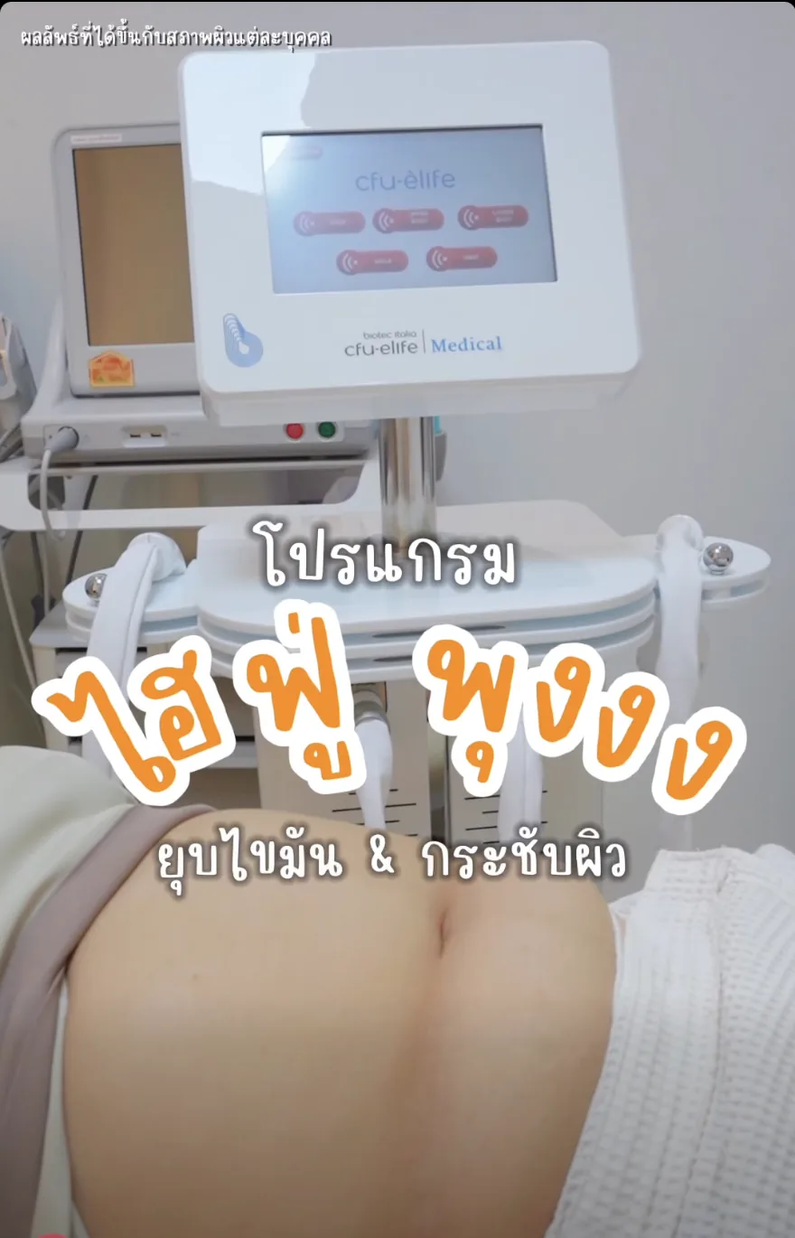 การทำ CFU-ÈLIFE บริเวณหน้าท้องด้วยหัวลำตัวที่พีซคลินิก แม่สอด