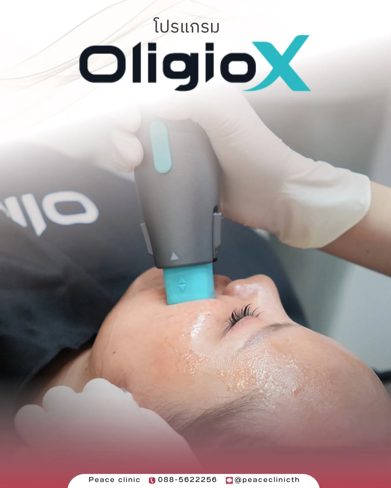 แพทย์กำลังทำ Oligio X บริเวณแก้มและกรอบหน้าที่พีซคลินิก แม่สอด เห็นหัวทรีตเมนต์และเจลนำคลื่นบนผิว