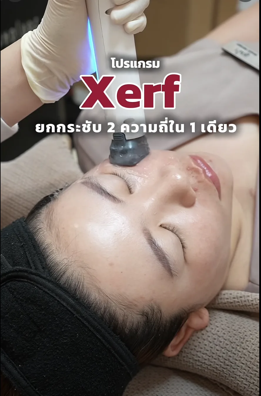 แพทย์กำลังทำ XERF บริเวณหน้าผากและรอบดวงตาที่พีซคลินิก แม่สอด