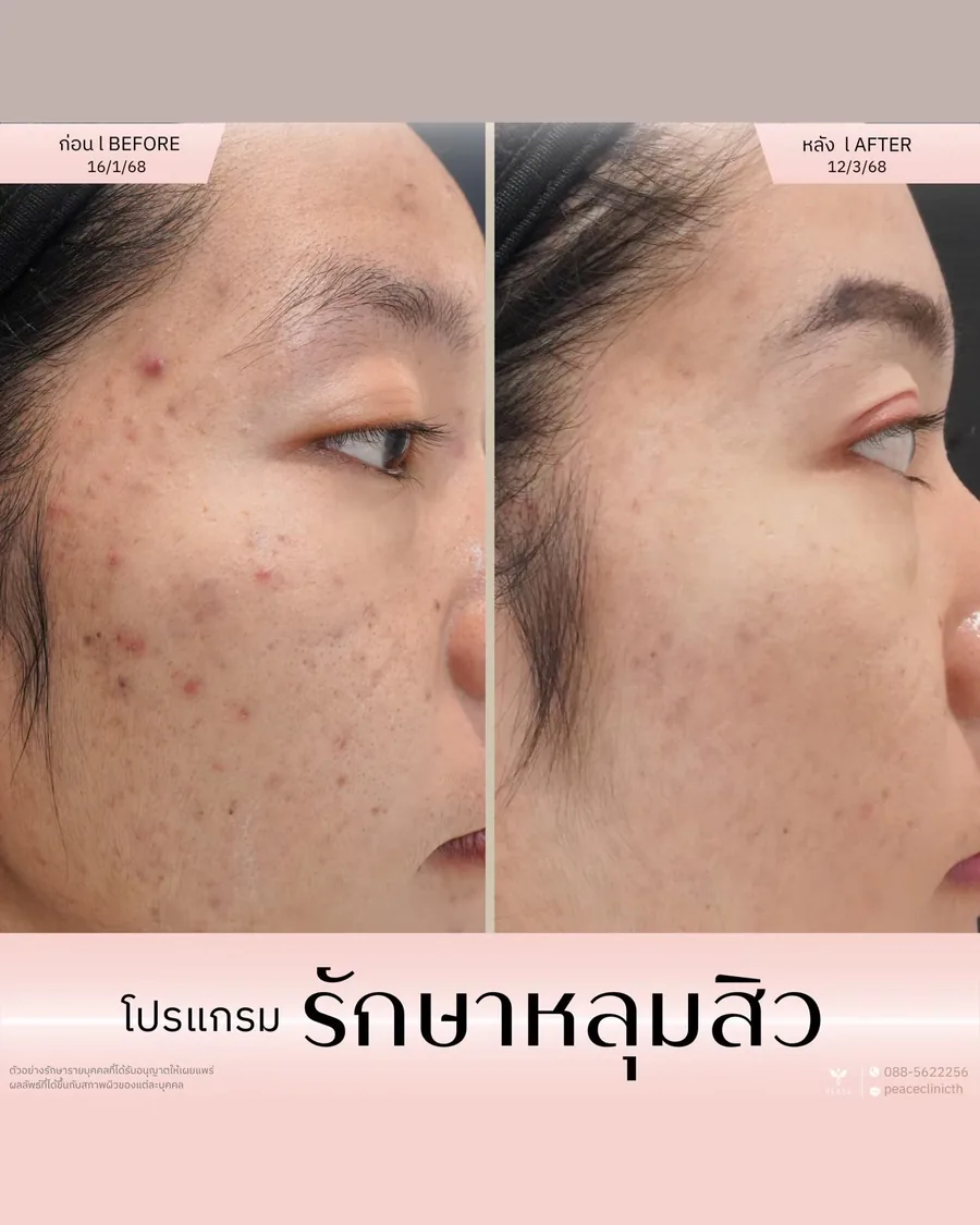 รักษาหลุมสิว — มุมเฉียง