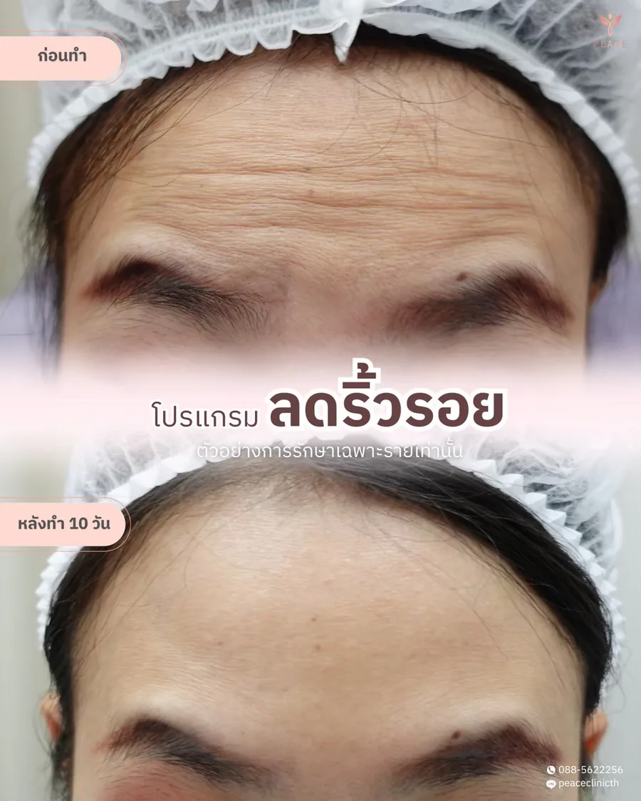 โบท็อกซ์ · ลดริ้วรอย — รอยหน้าผาก · หลังทำ 10 วัน