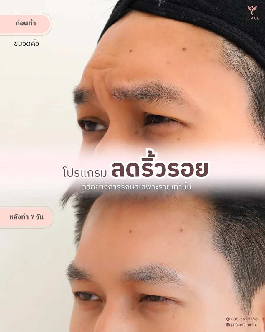 โบท็อกซ์ · ลดริ้วรอย — รอยขมวดคิ้ว · หลังทำ 7 วัน