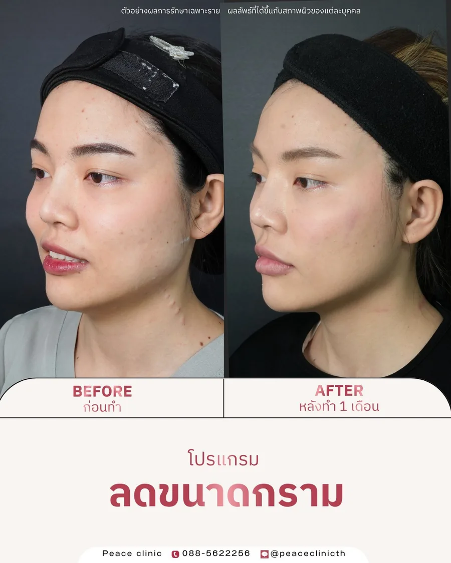 โบท็อกซ์ · ลดขนาดกราม — มุมเฉียง · หลังทำ 1 เดือน
