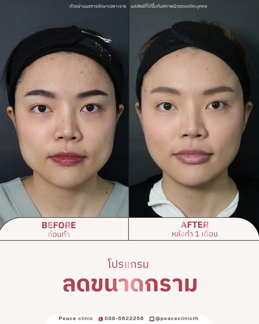 โบท็อกซ์ · ลดขนาดกราม — หน้าตรง · หลังทำ 1 เดือน