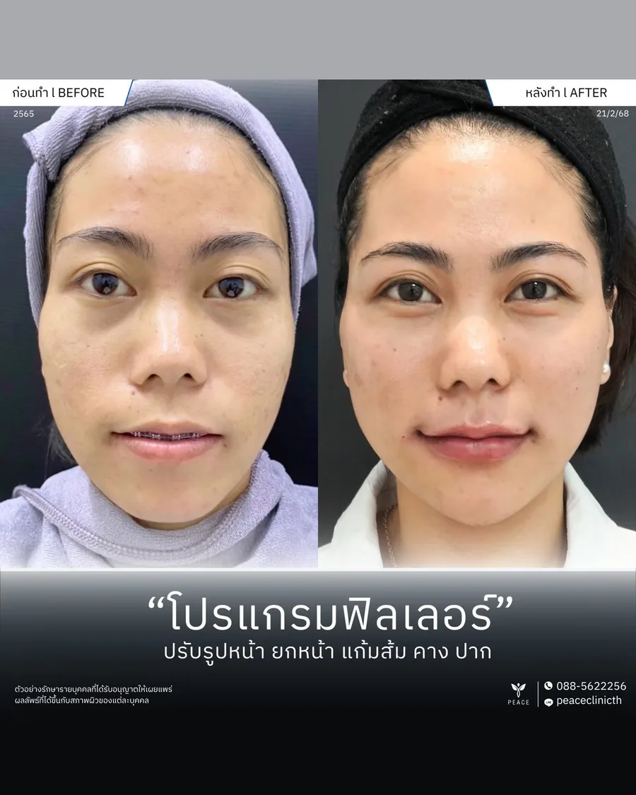 ฟิลเลอร์ · ปรับรูปหน้า — หน้าตรง
