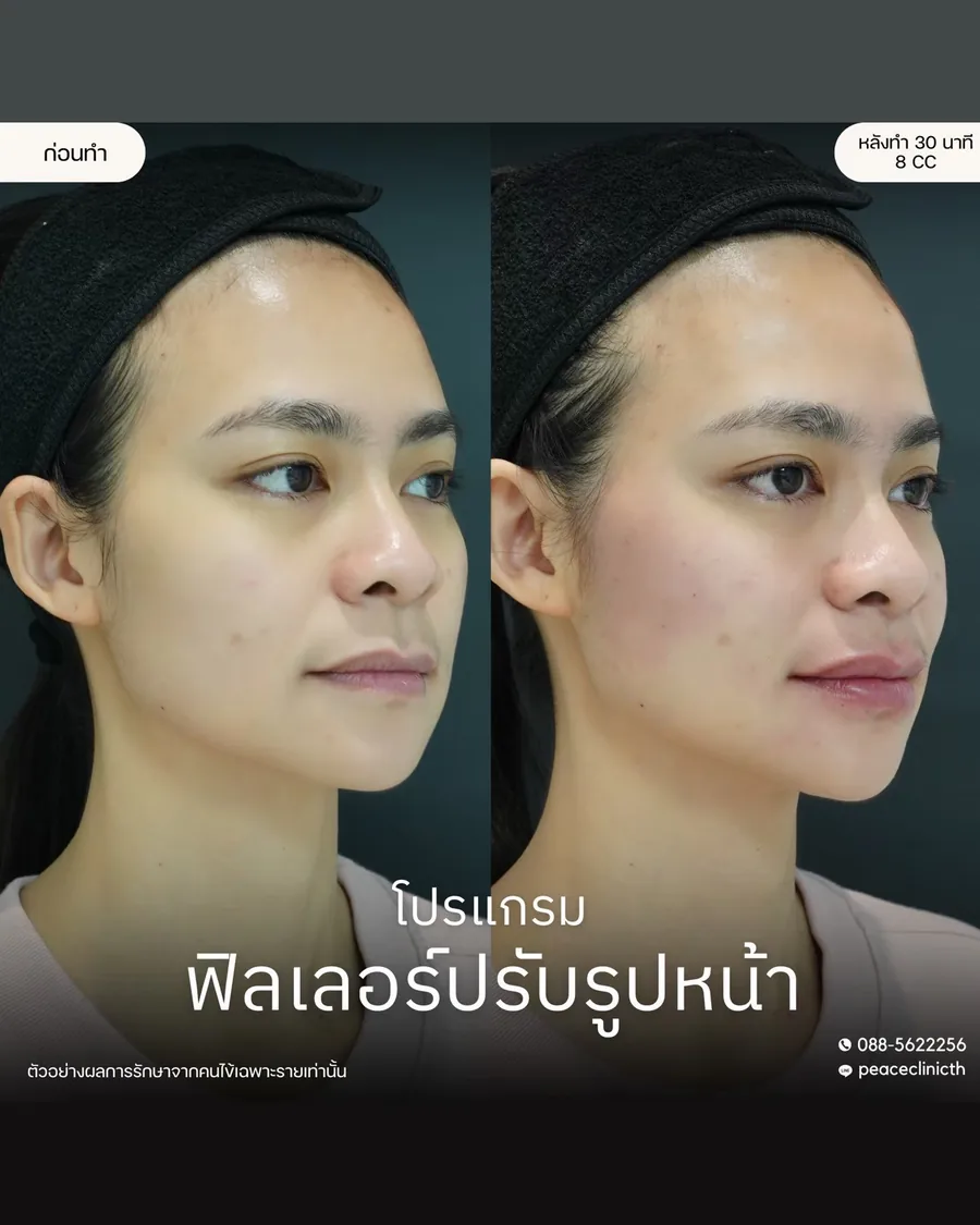 ฟิลเลอร์ · ปรับรูปหน้า — มุมเฉียง