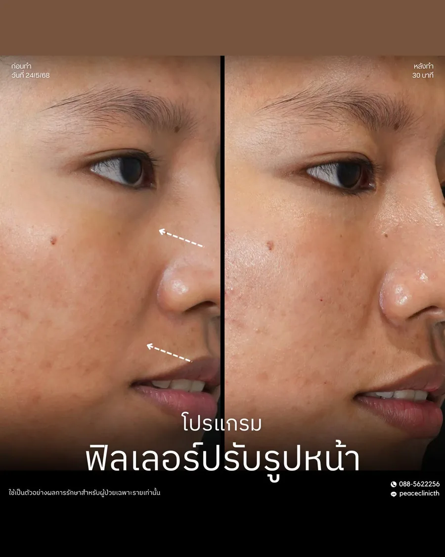 ฟิลเลอร์ · ใต้ตา — หลังทำ 30 นาที