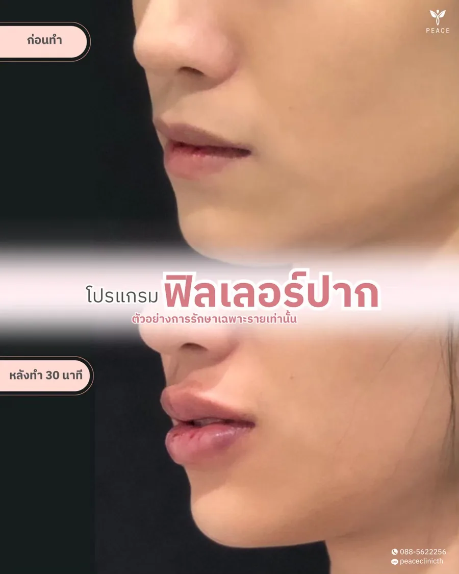 ฟิลเลอร์ · ปาก — มุมด้านข้าง · หลังทำ 30 นาที