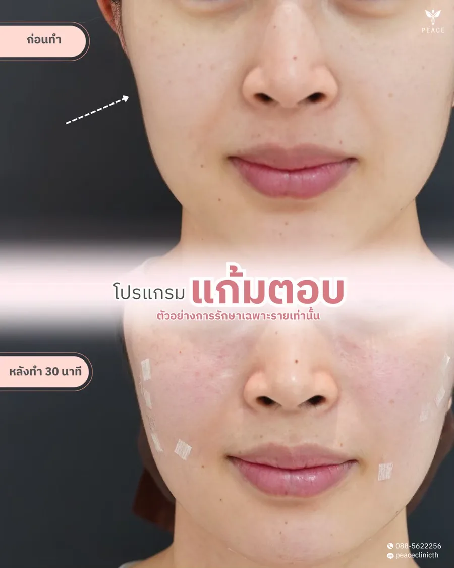 ฟิลเลอร์ · แก้มตอบ — หลังทำ 30 นาที