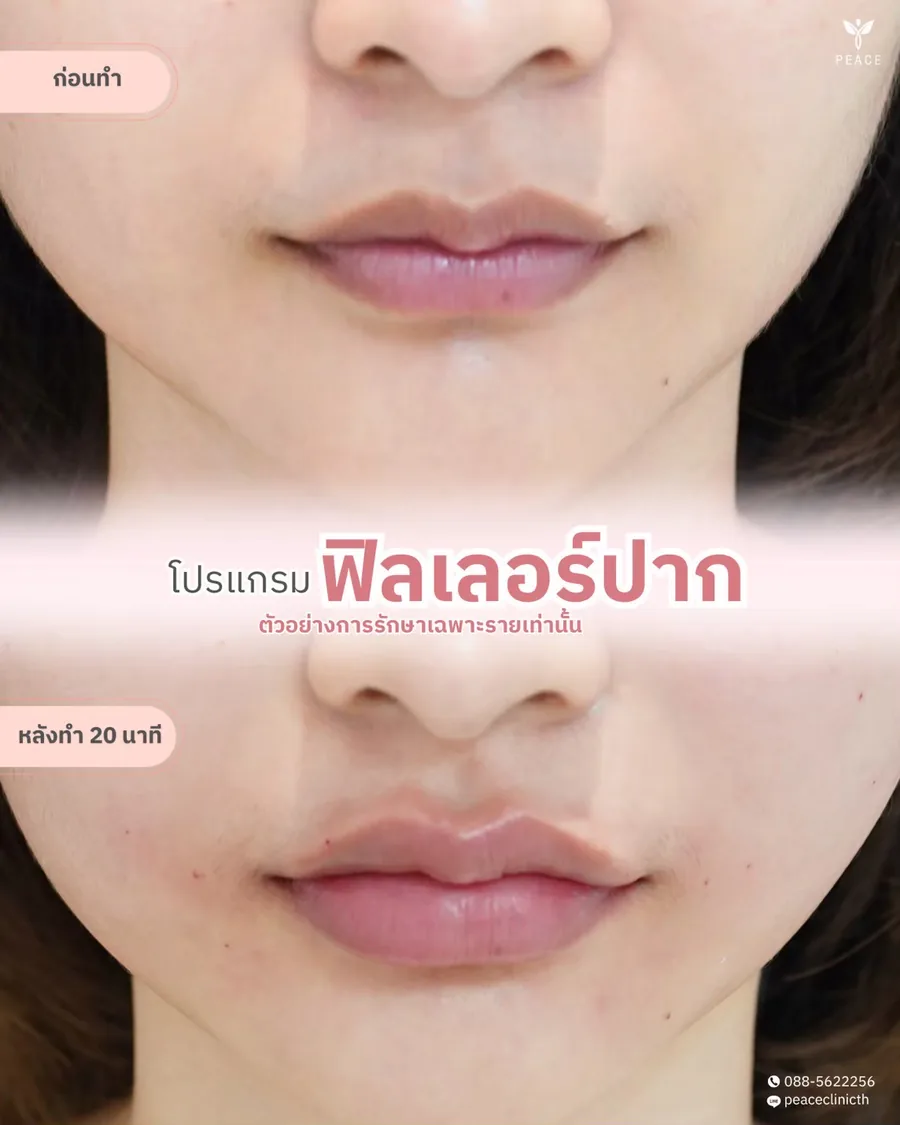 ฟิลเลอร์ · ปาก — หลังทำ 20 นาที