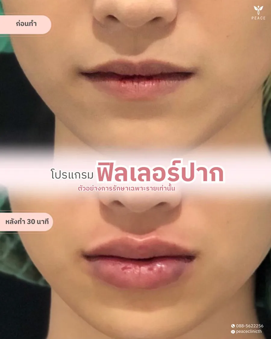 ฟิลเลอร์ · ปาก — หลังทำ 30 นาที