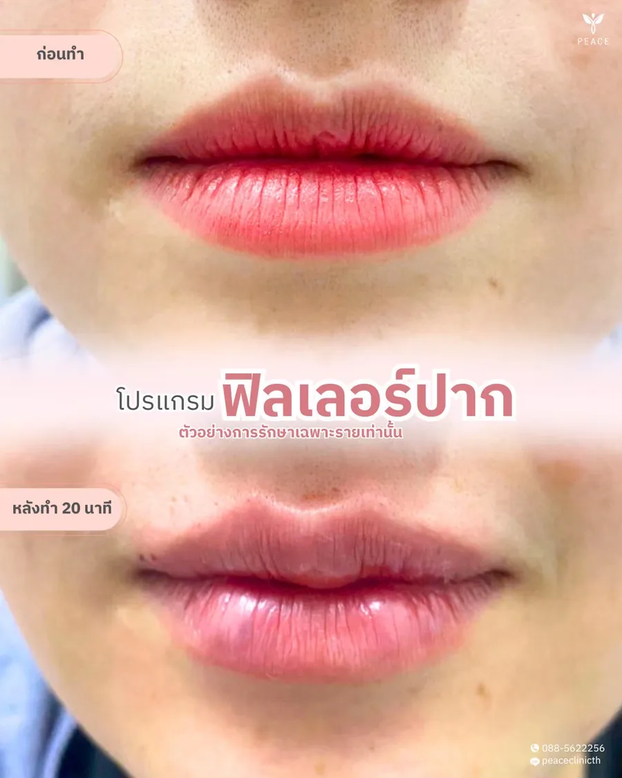 ฟิลเลอร์ · ปาก — ระยะใกล้ · หลังทำ 20 นาที