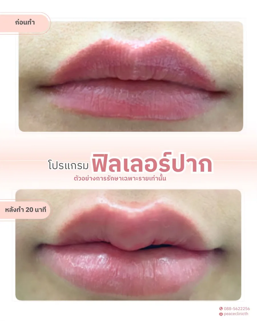 ฟิลเลอร์ · ปาก — ระยะใกล้ · หลังทำ 20 นาที