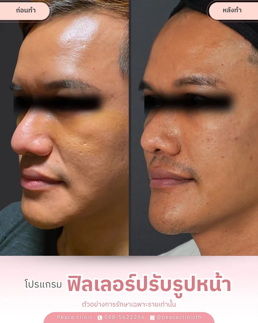 ฟิลเลอร์ · ปรับรูปหน้า — มุมเฉียง
