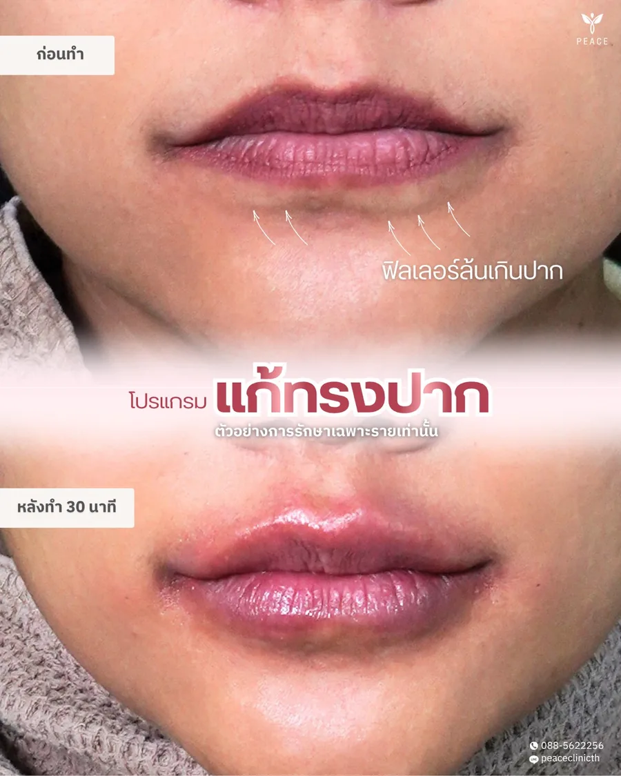 ฟิลเลอร์ · แก้ทรงปาก — ละลายฟิลเลอร์เดิม · หลังทำ 30 นาที