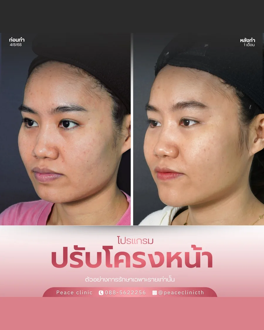 ฟิลเลอร์ · ปรับโครงหน้า — หน้าตรง