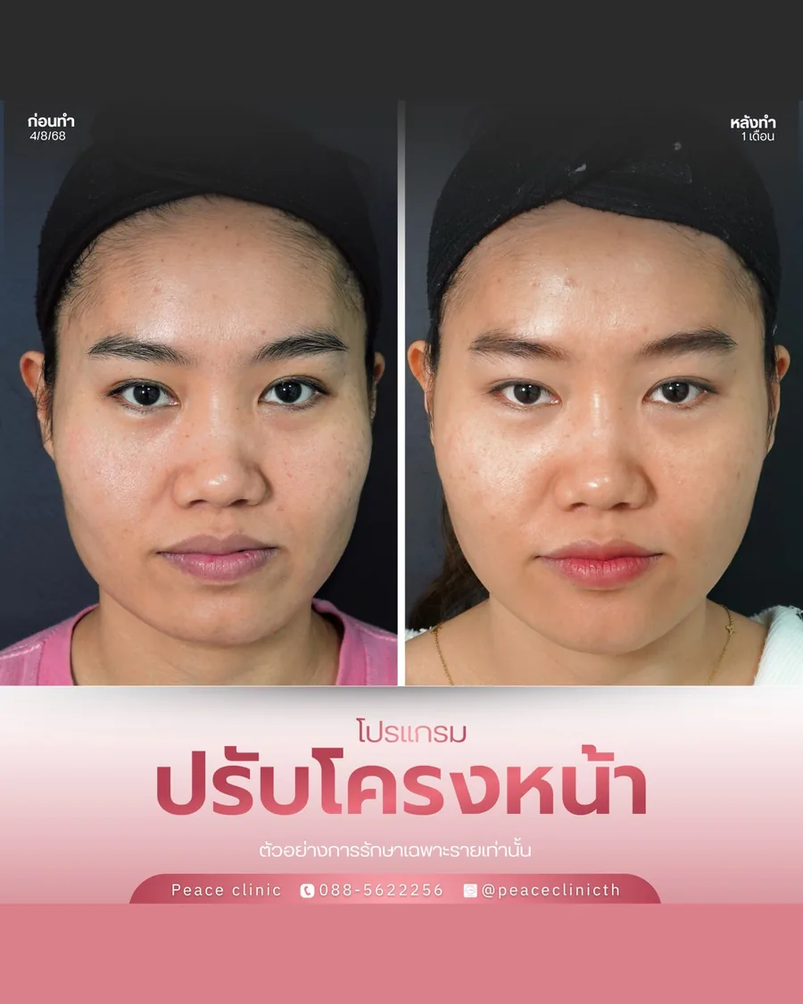 ฟิลเลอร์ · ปรับโครงหน้า — หน้าตรง