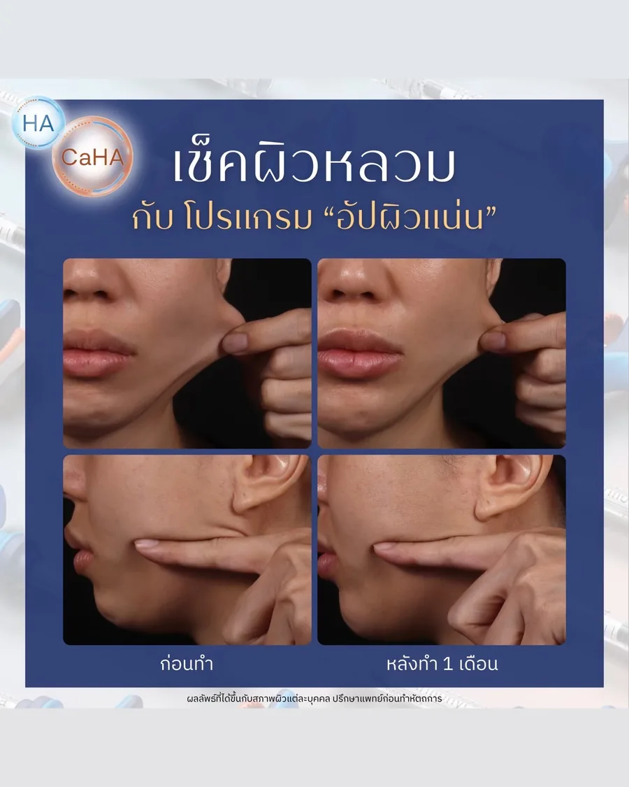 HArmonyCa · ยกกระชับ — กรอบหน้าและใต้คาง · หลังทำ 1 เดือน