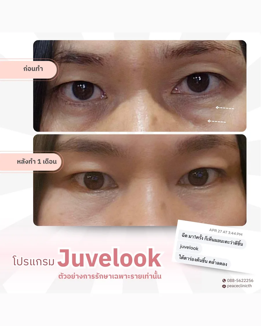 Juvelook · ใต้ตา — หลังทำ 1 เดือน