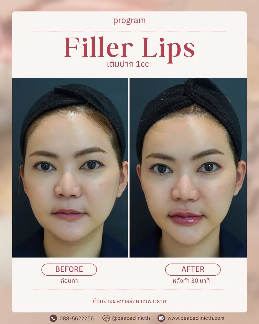 ฟิลเลอร์ปาก 1 cc — ภาพรวมใบหน้า · หลังทำ 30 นาที