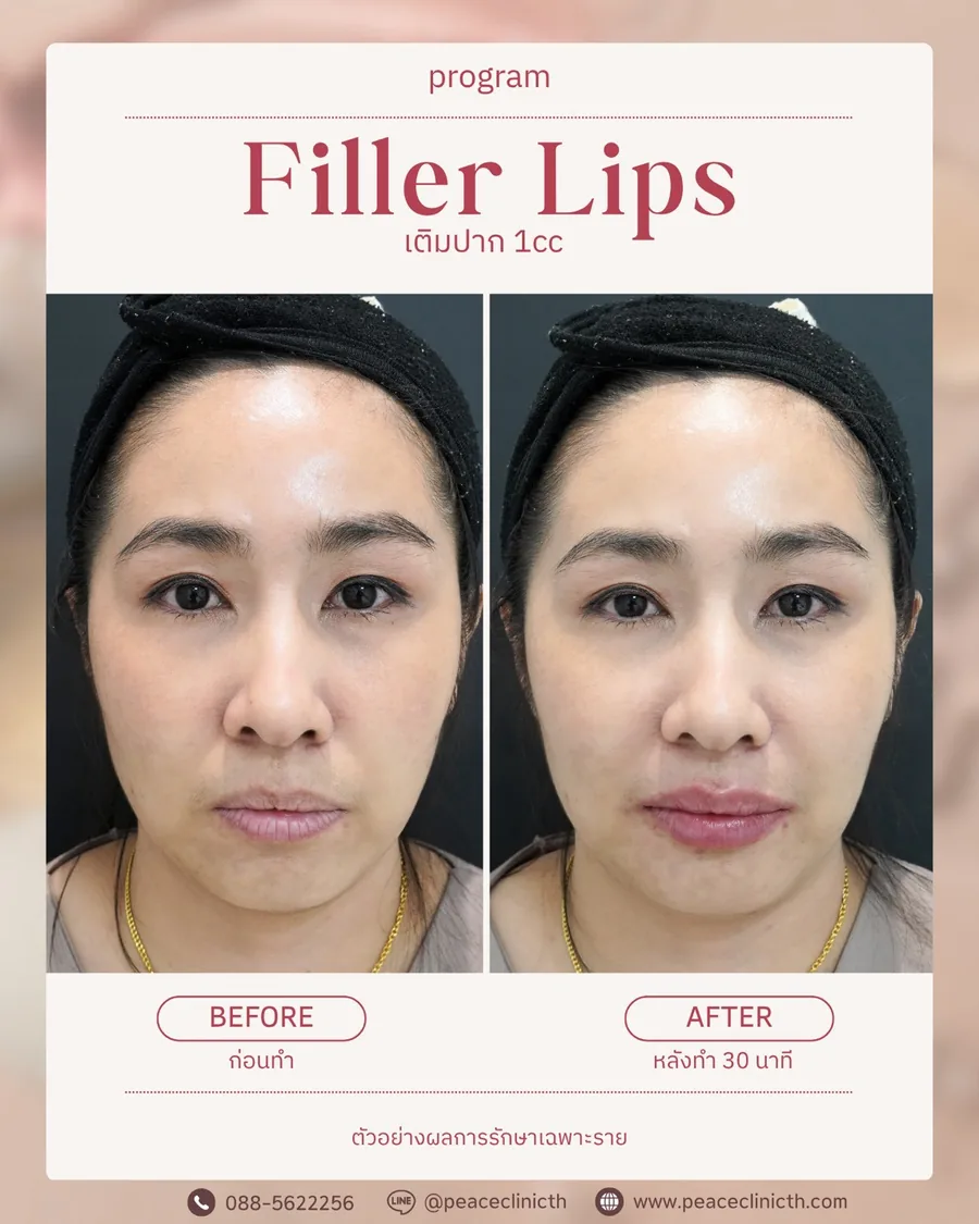 ฟิลเลอร์ปาก 1 cc — ภาพรวมใบหน้า · หลังทำ 30 นาที
