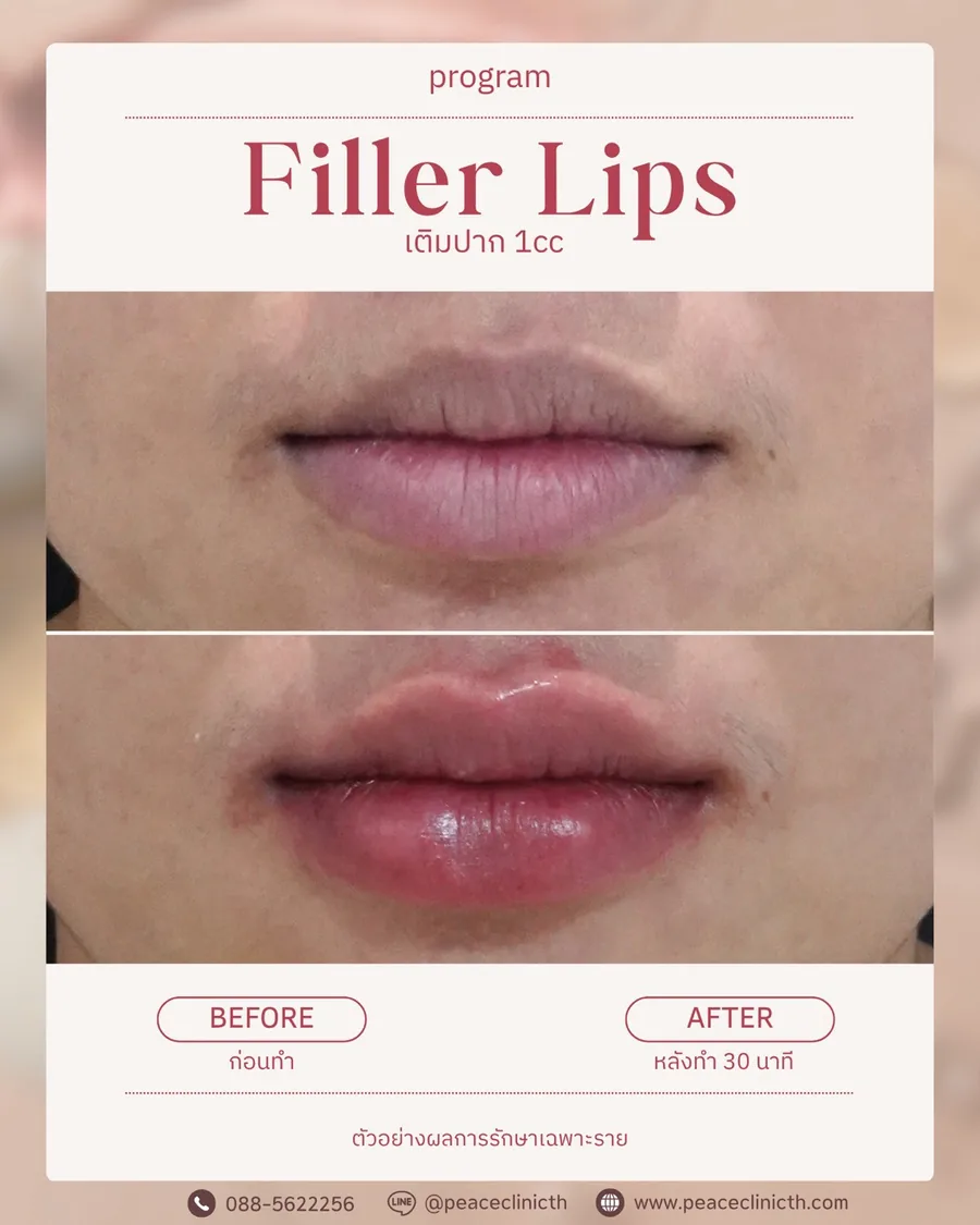 ฟิลเลอร์ปาก 1 cc — ระยะใกล้ · หลังทำ 30 นาที