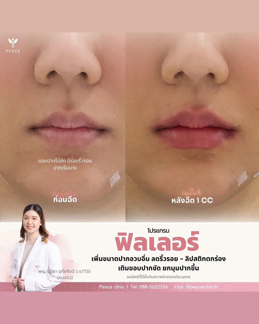 ฟิลเลอร์ · ปาก — ก่อน–หลังฉีด 1 CC
