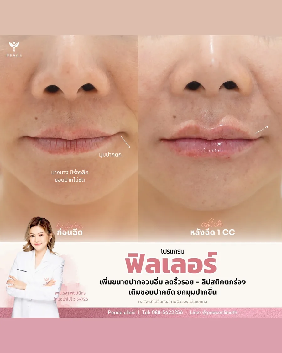ฟิลเลอร์ · ปาก — ก่อน–หลังฉีด 1 CC