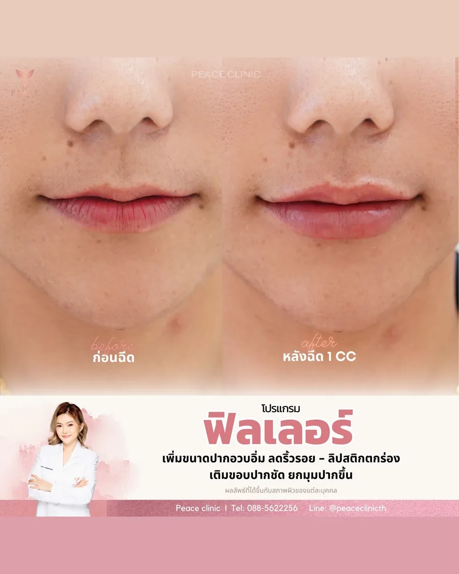 ฟิลเลอร์ · ปาก — ก่อน–หลังฉีด 1 CC