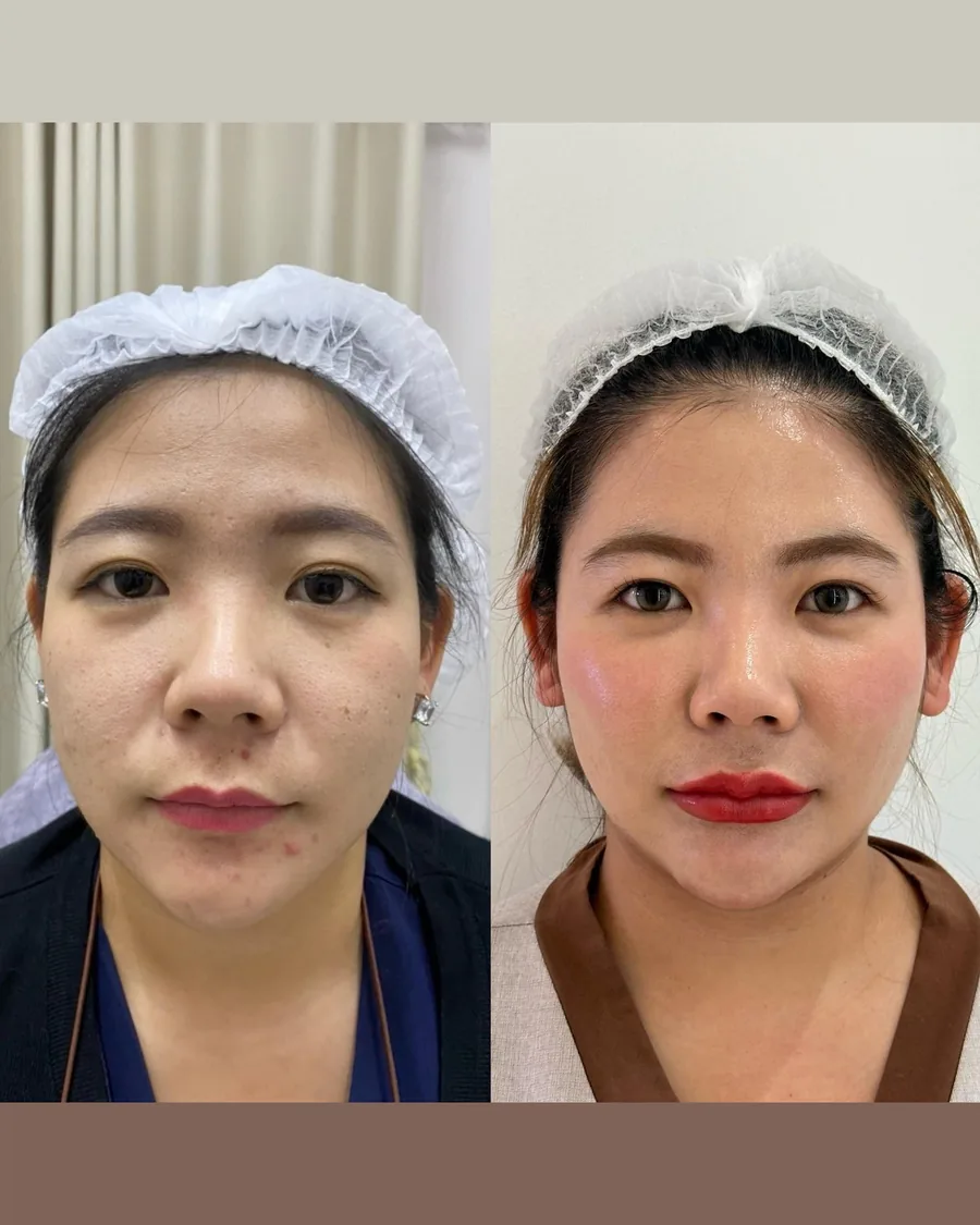 ฟิลเลอร์ · ปาก — ภาพรวมใบหน้า