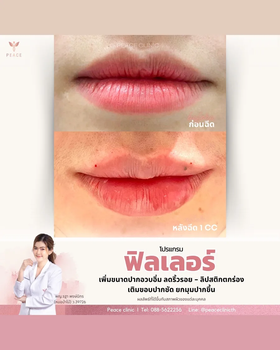 ฟิลเลอร์ · ปาก — ระยะใกล้ · หลังฉีด 1 CC