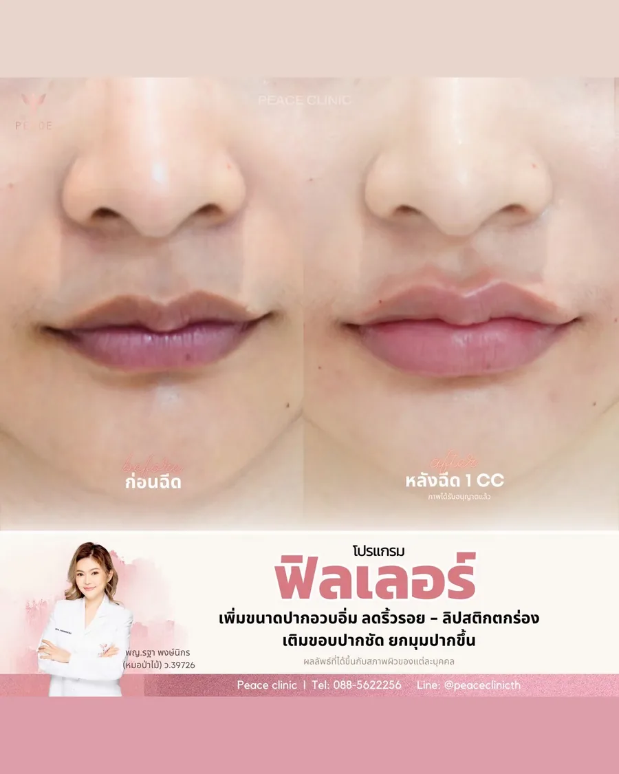 ฟิลเลอร์ · ปาก — ก่อน–หลังฉีด 1 CC