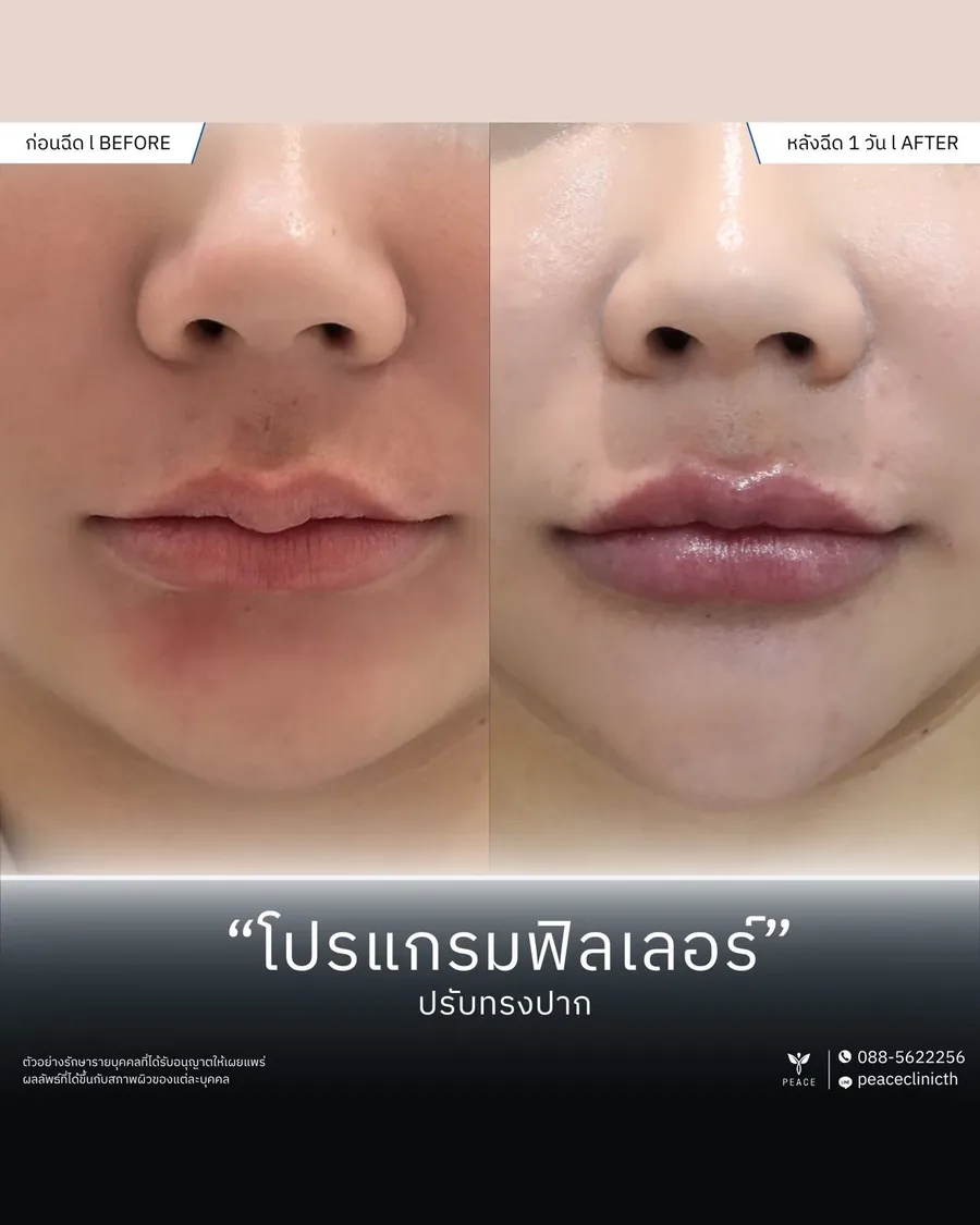 ฟิลเลอร์ · ปรับทรงปาก — หลังฉีด 1 วัน