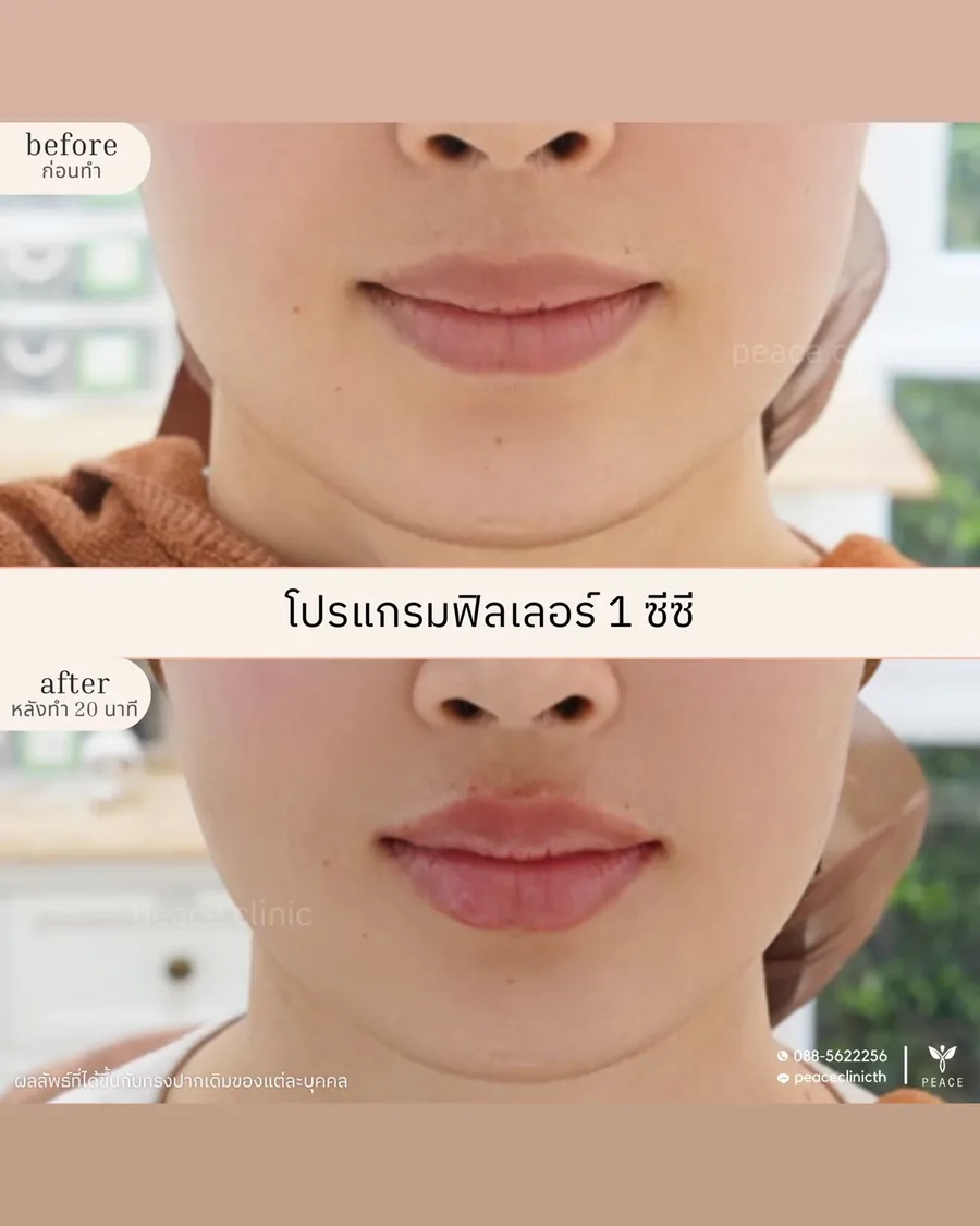 ฟิลเลอร์ · ปาก 1 ซีซี — หน้าตรง · หลังทำ 20 นาที