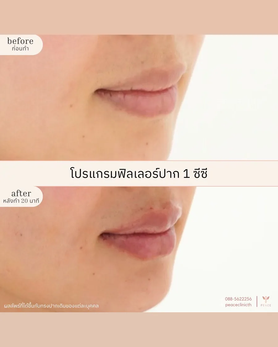 ฟิลเลอร์ · ปาก 1 ซีซี — มุมเฉียง · หลังทำ 20 นาที