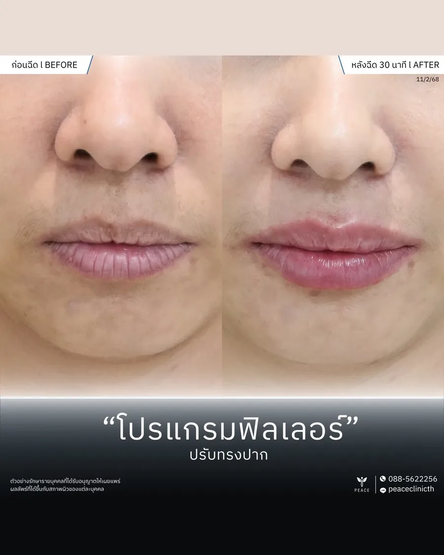 ฟิลเลอร์ · ปรับทรงปาก — หลังฉีด 30 นาที