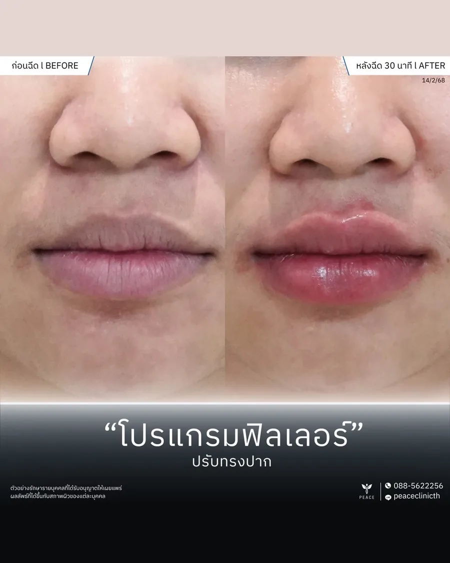 ฟิลเลอร์ · ปรับทรงปาก — หลังฉีด 30 นาที