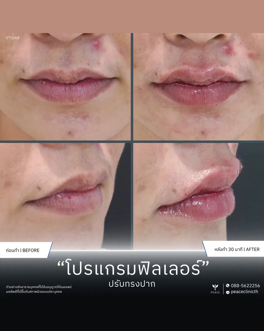 ฟิลเลอร์ · ปรับทรงปาก — หน้าตรงและมุมเฉียง