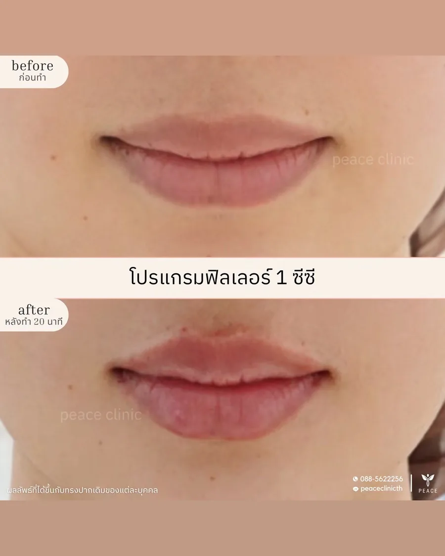 ฟิลเลอร์ · ปาก 1 ซีซี — หน้าตรง · หลังทำ 20 นาที