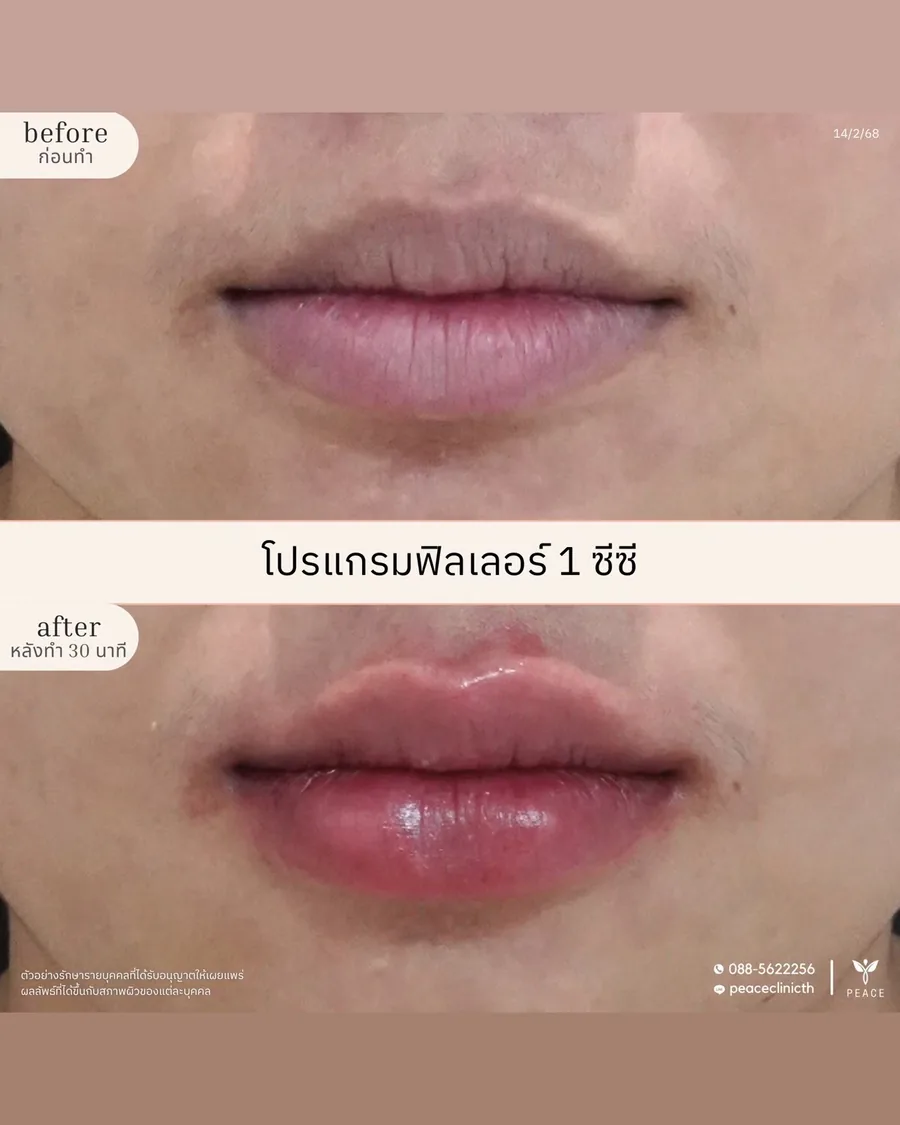 ฟิลเลอร์ · ปาก 1 ซีซี — หน้าตรง · หลังทำ 30 นาที