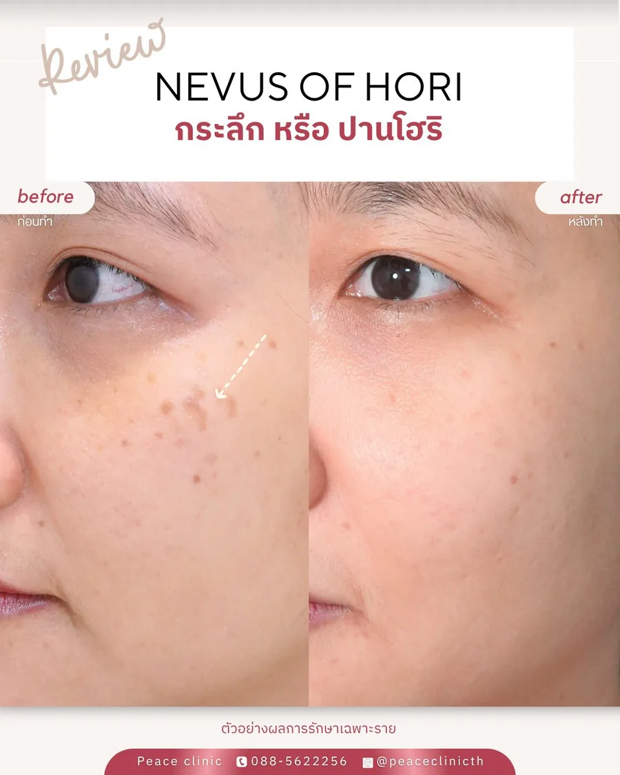 PicoSure · ปานโฮริ (กระลึก) — โหนกแก้ม · มุมเฉียง