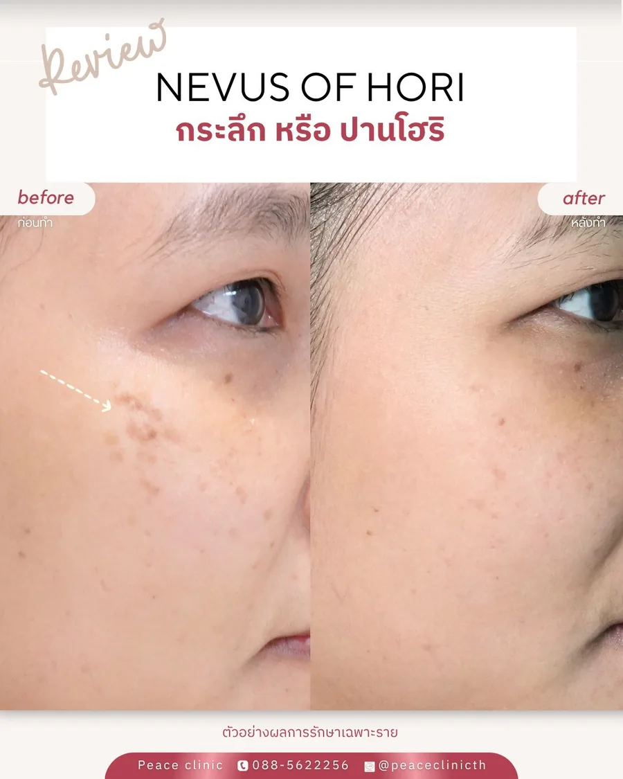 PicoSure · ปานโฮริ (กระลึก) — โหนกแก้มและขมับ