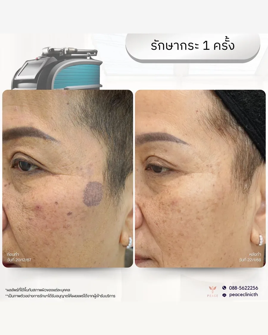 PicoSure · รักษากระ — จุดด่างดำที่แก้ม · หลังทำ 1 ครั้ง