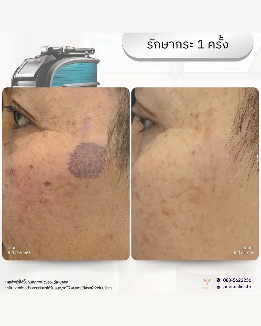 PicoSure · รักษากระ — จุดด่างดำที่แก้ม · หลังทำ 1 ครั้ง