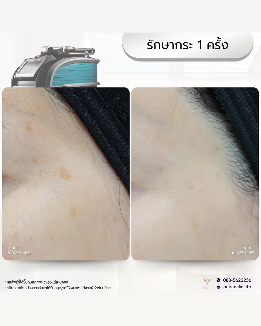 PicoSure · รักษากระ — บริเวณขมับ · หลังทำ 1 ครั้ง