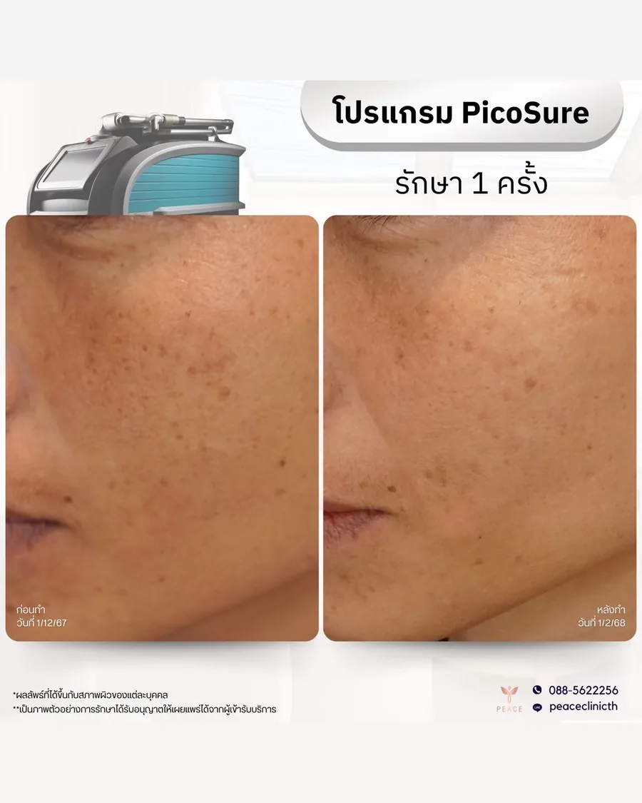 PicoSure · รักษากระ — แก้มและโหนกแก้ม · หลังทำ 1 ครั้ง