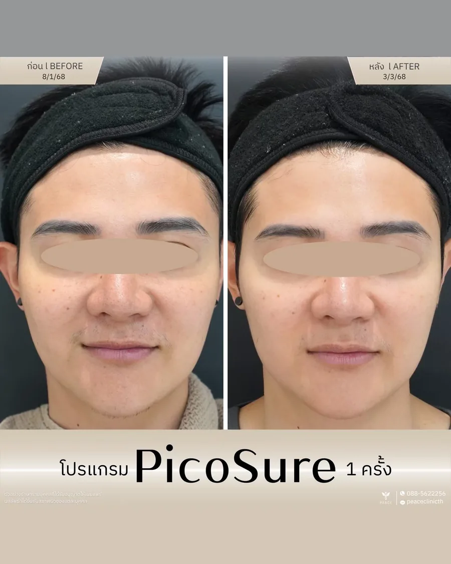 PicoSure · จุดด่างดำ — หน้าตรง · หลังทำ 1 ครั้ง
