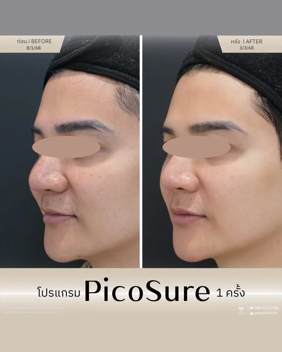 PicoSure · จุดด่างดำ — มุมเฉียง · หลังทำ 1 ครั้ง