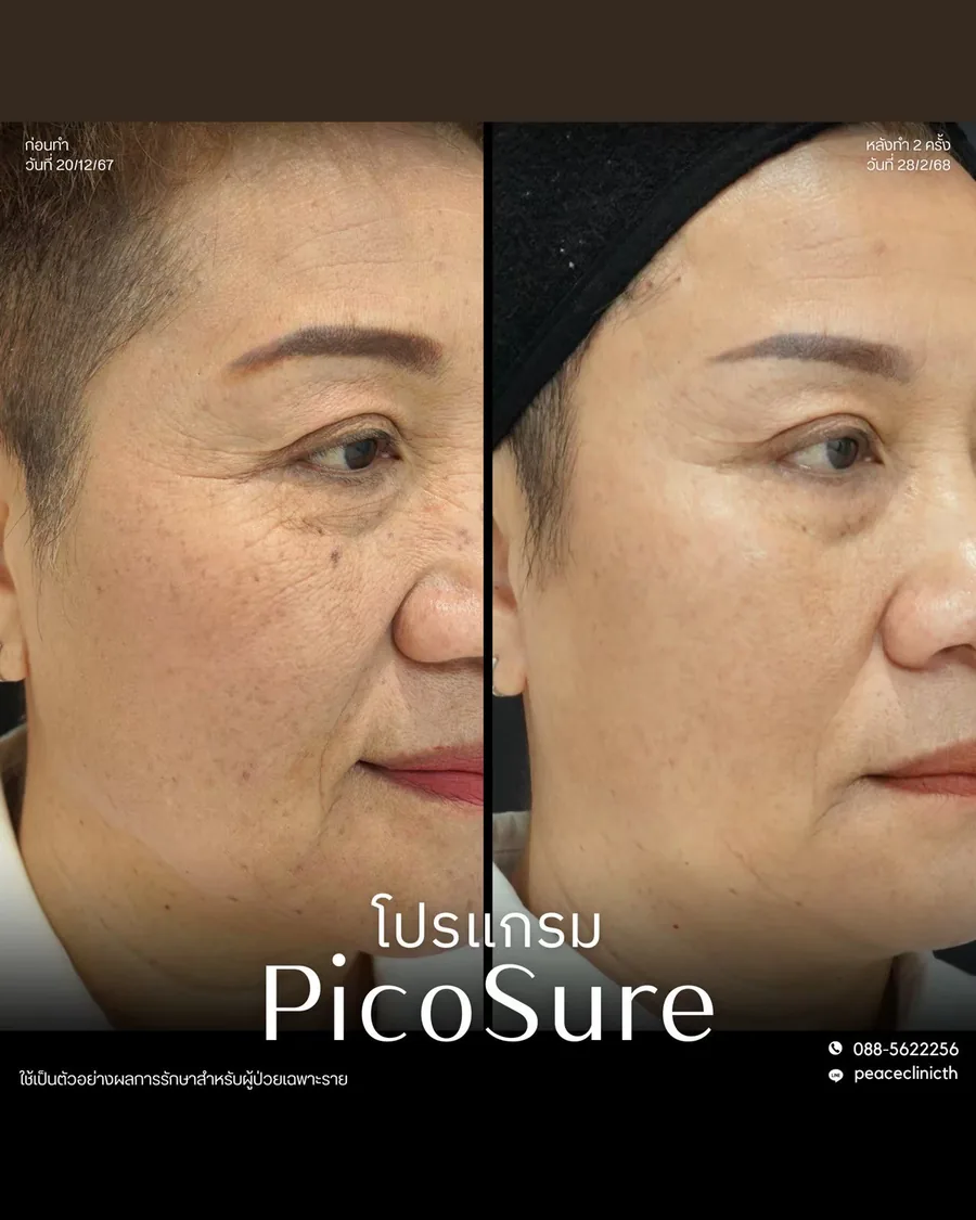 PicoSure · จุดด่างดำ — มุมเฉียง