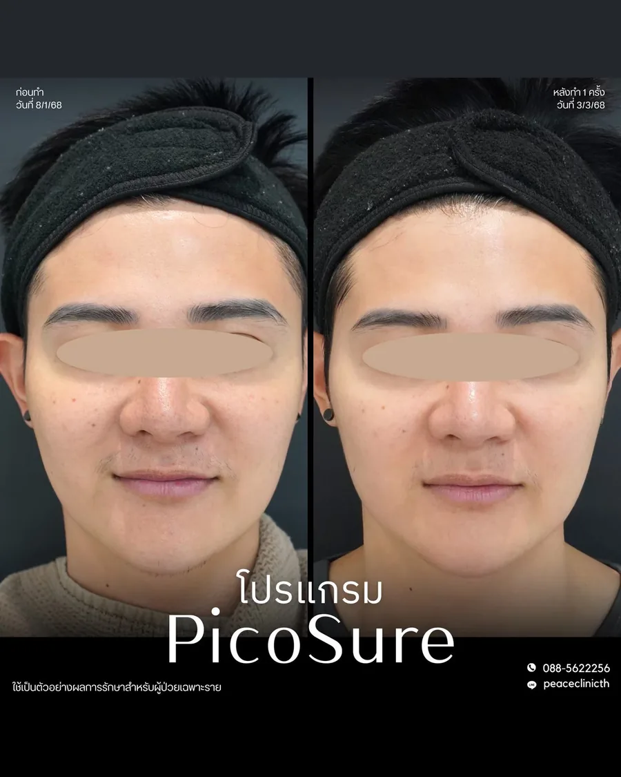 PicoSure · จุดด่างดำ — หน้าตรง